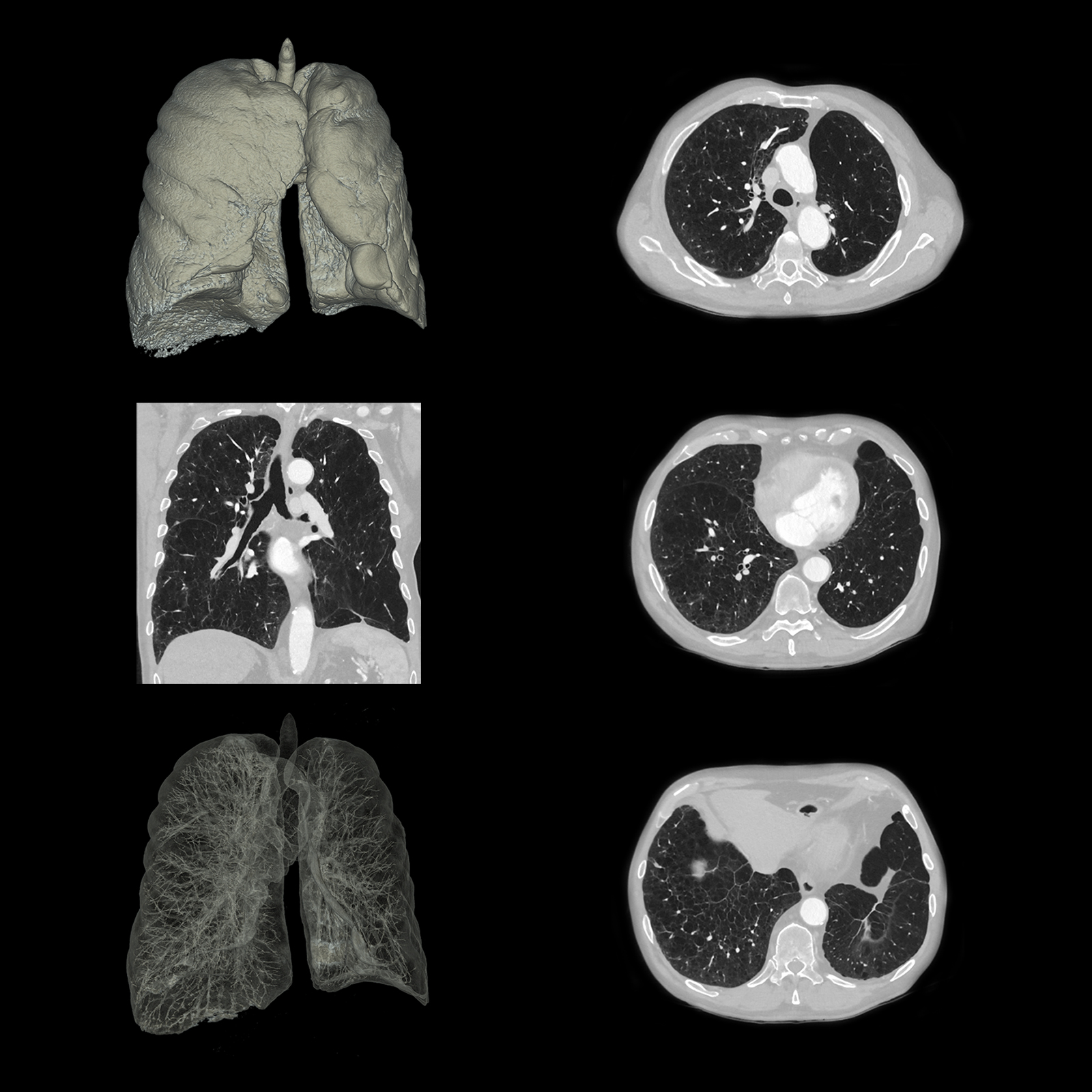 Lung Emphysema, AiCE