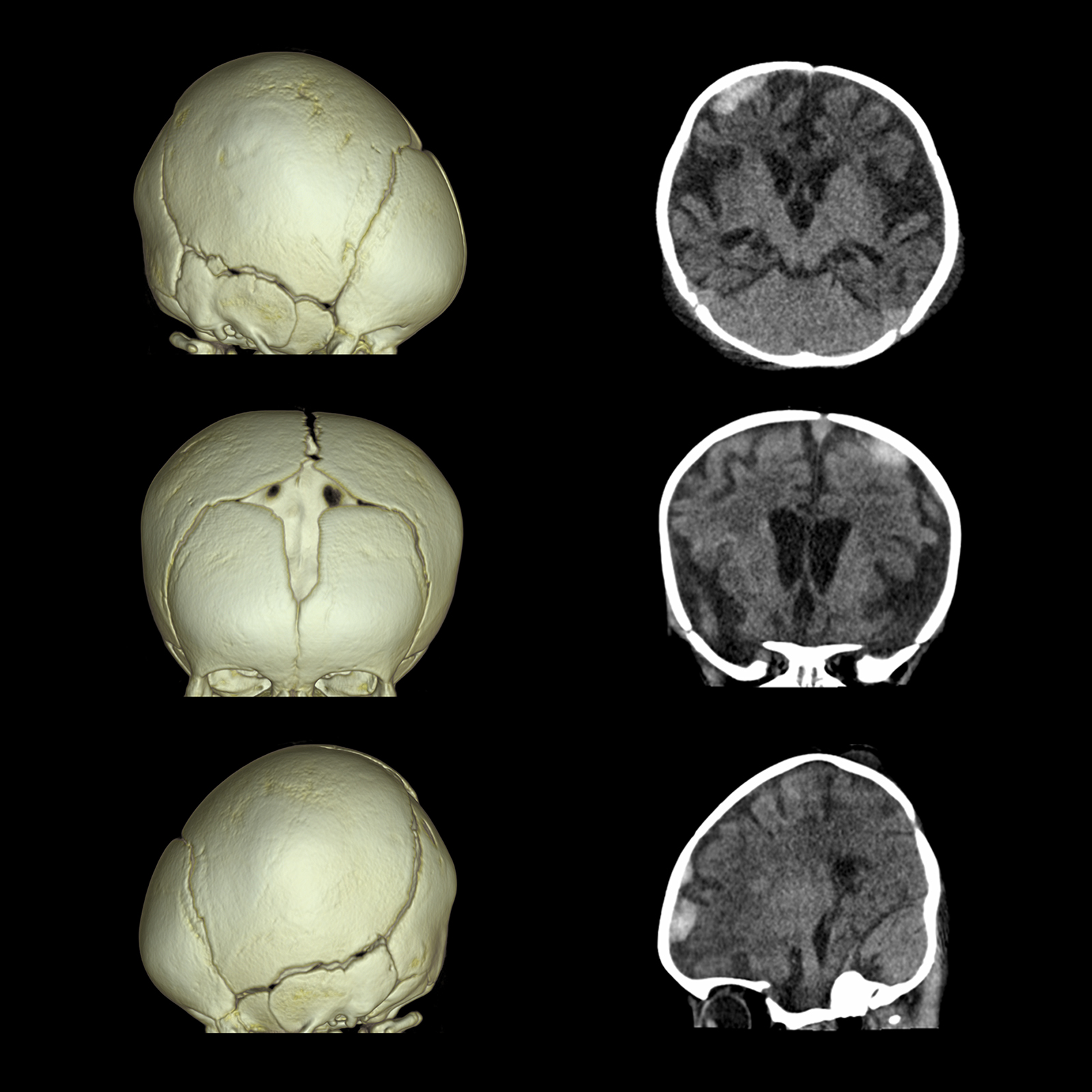 Brain Subdural Hematoma, Volume