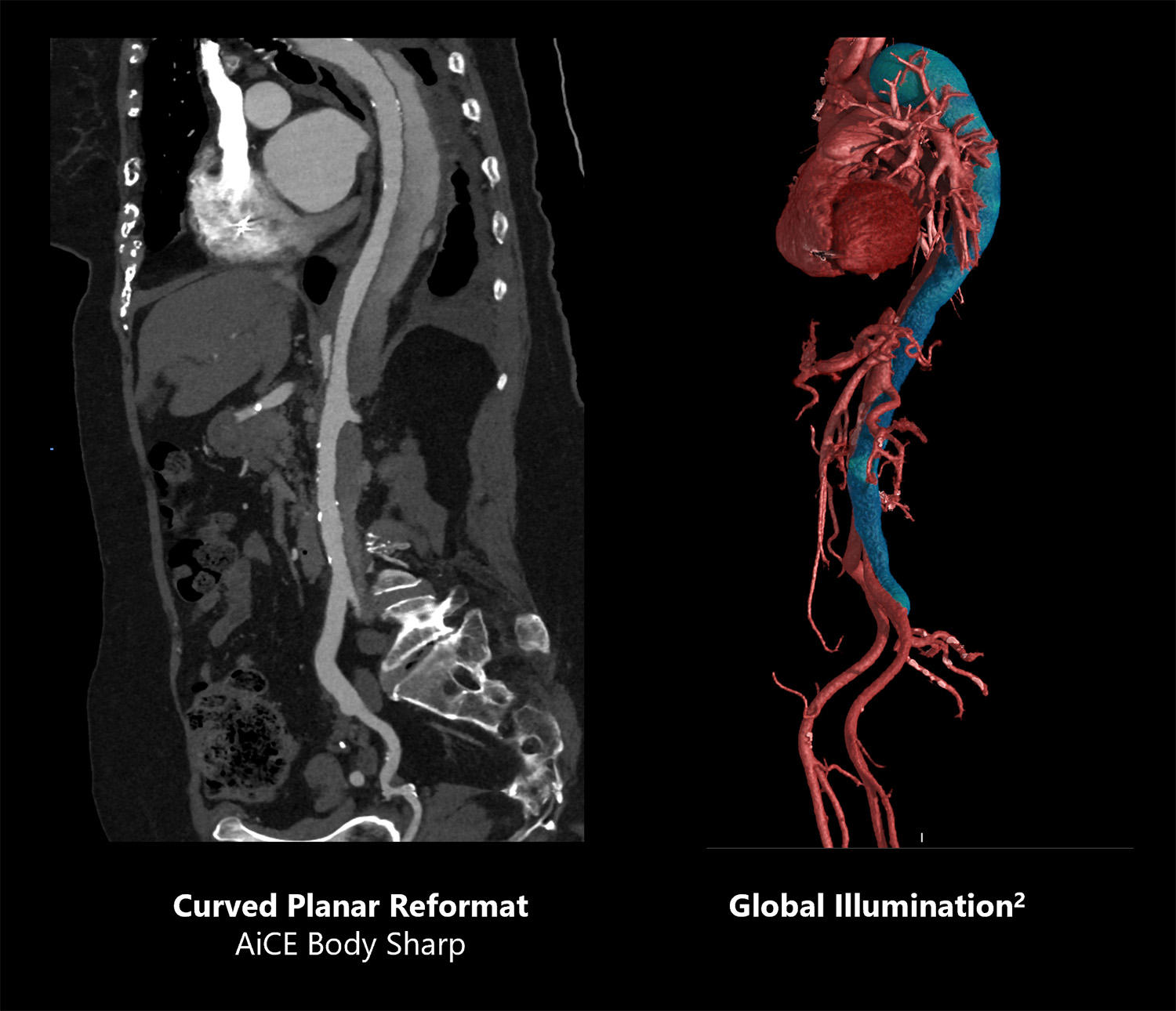 Curved Planar Reformat AiCE Body Sharp | Global Illumination