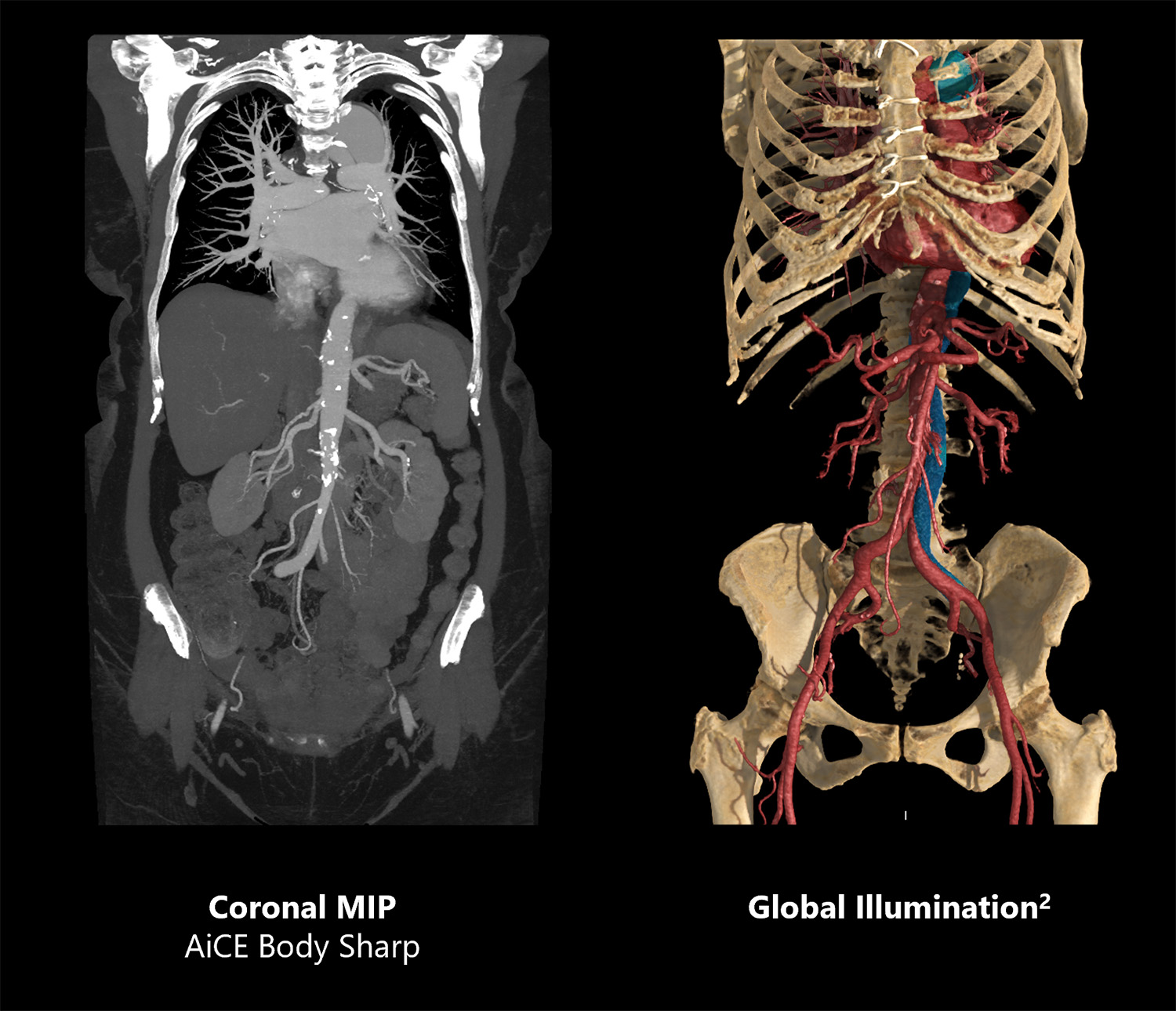 Coronal MP AiCE Body Sharp | Global Illumination