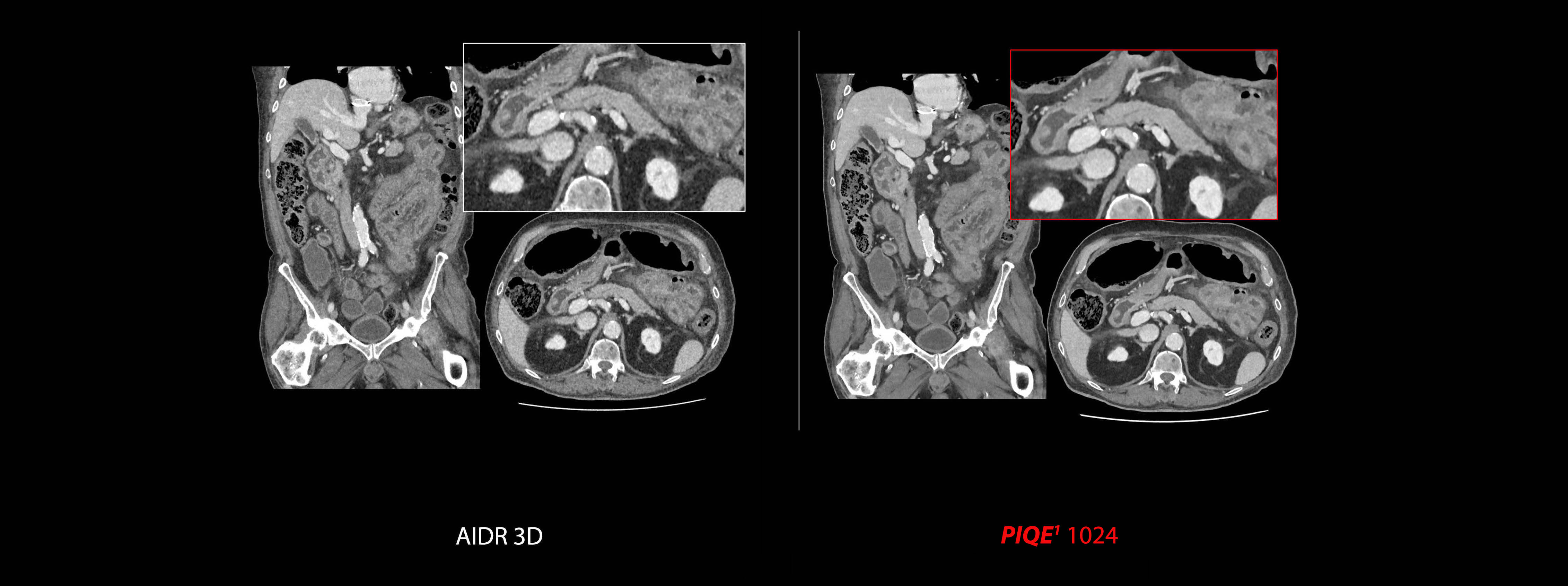 PIQE 1024 DLR: Abdominal