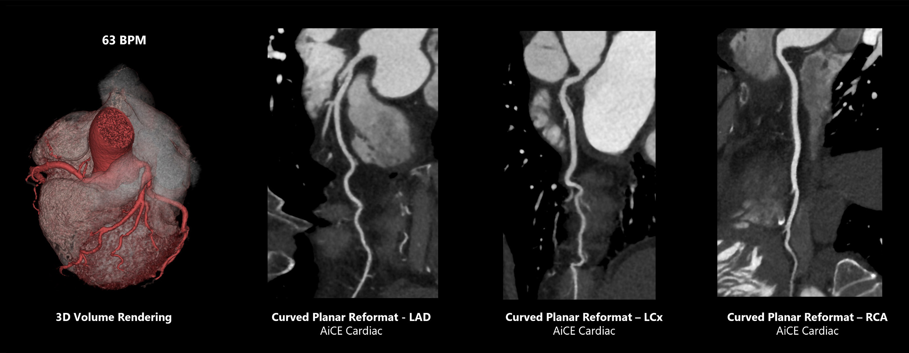 3D Volume Rendering | Curved Planar Reformat - LAD AiCE Cardiac | Curved Planar Reformat - LCx AiCE Cardiac | Curved Planar Reformat - RCA AiCE Cardiac