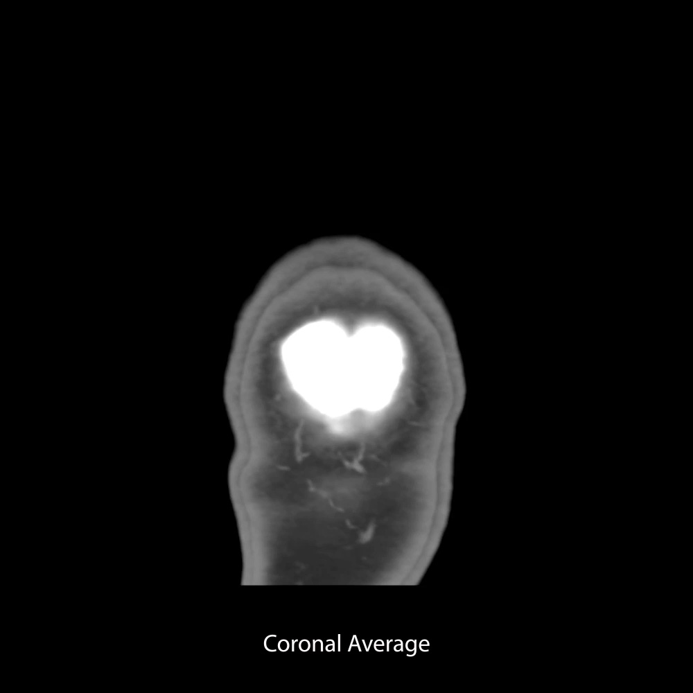 Coronal Average