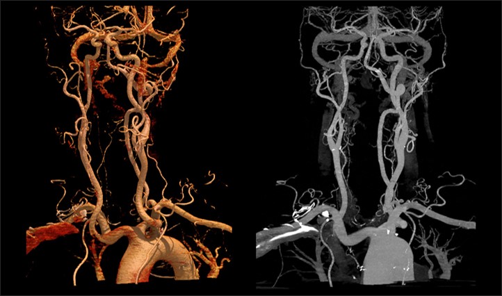 SURESubtraction* Carotid CTA