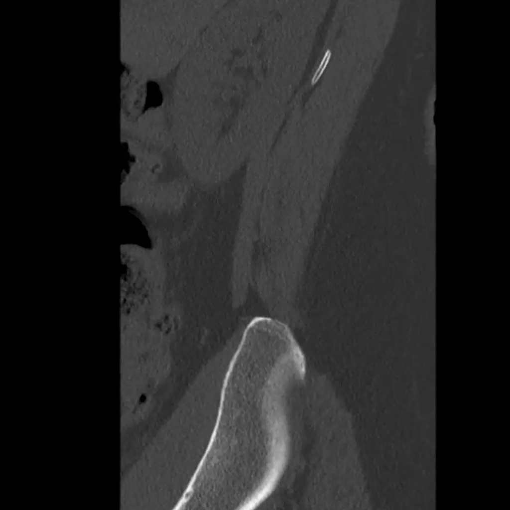 Sagittal Bone Lower Spine