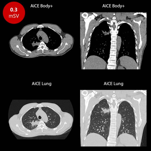 Low Dose Screening Chest with SilverBeam