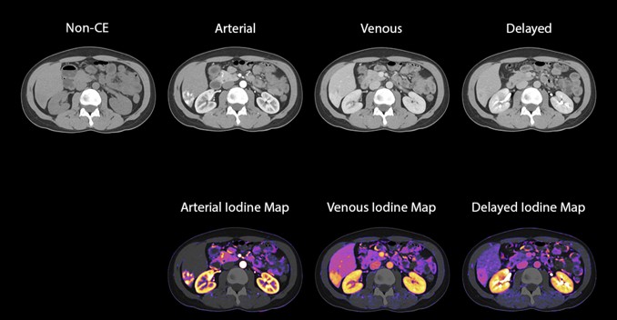 Liver Lesion with SURESubtraction* Iodine Maps