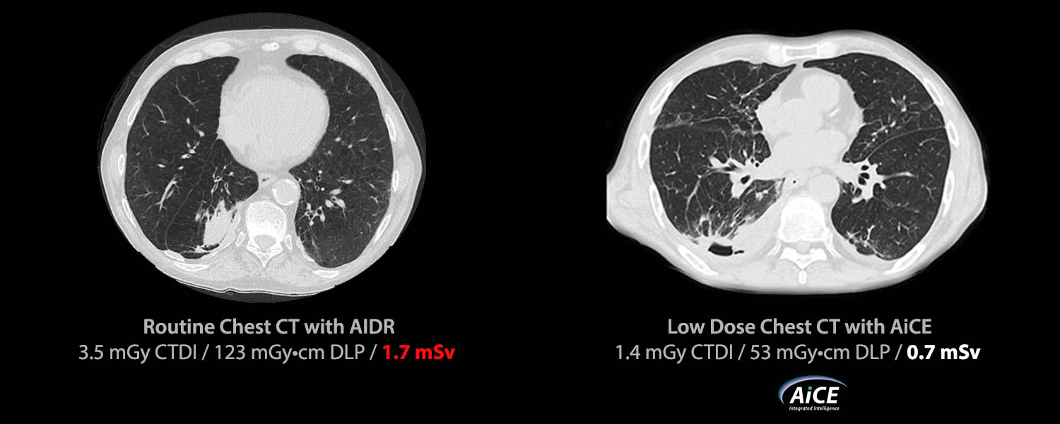 Low Dose Lung Screening