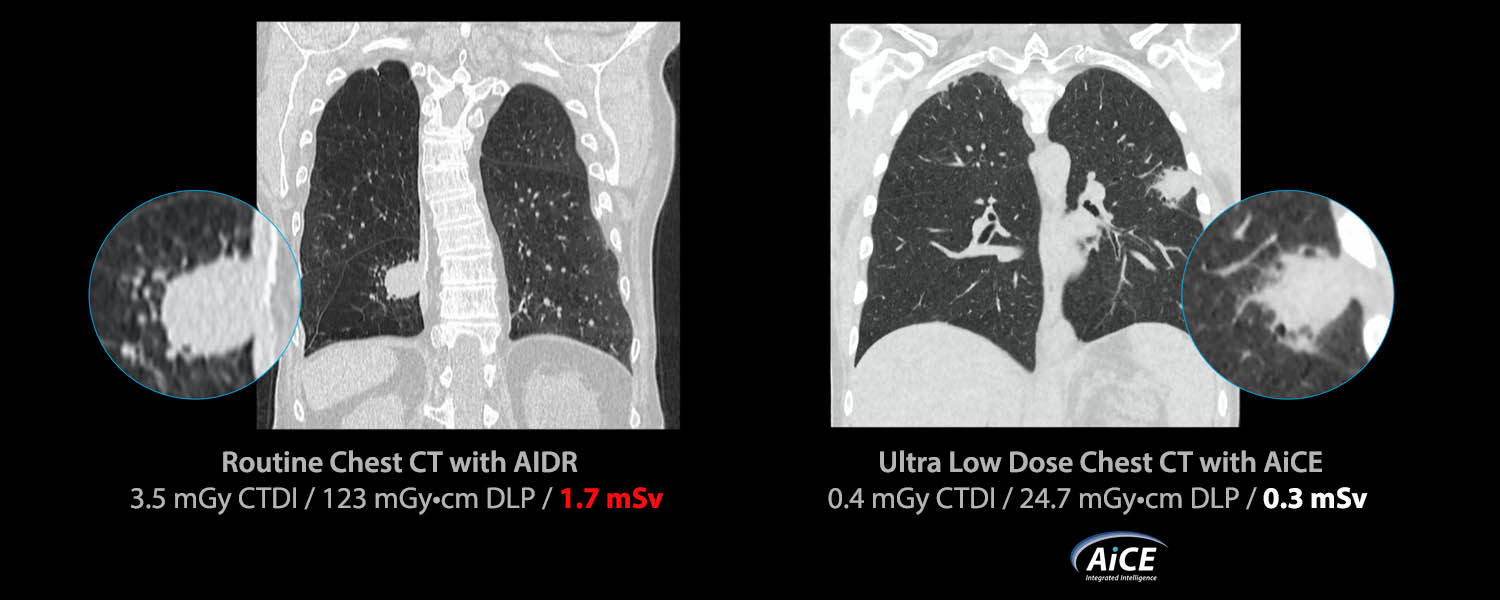 Ultra Low Dose Lung Screening