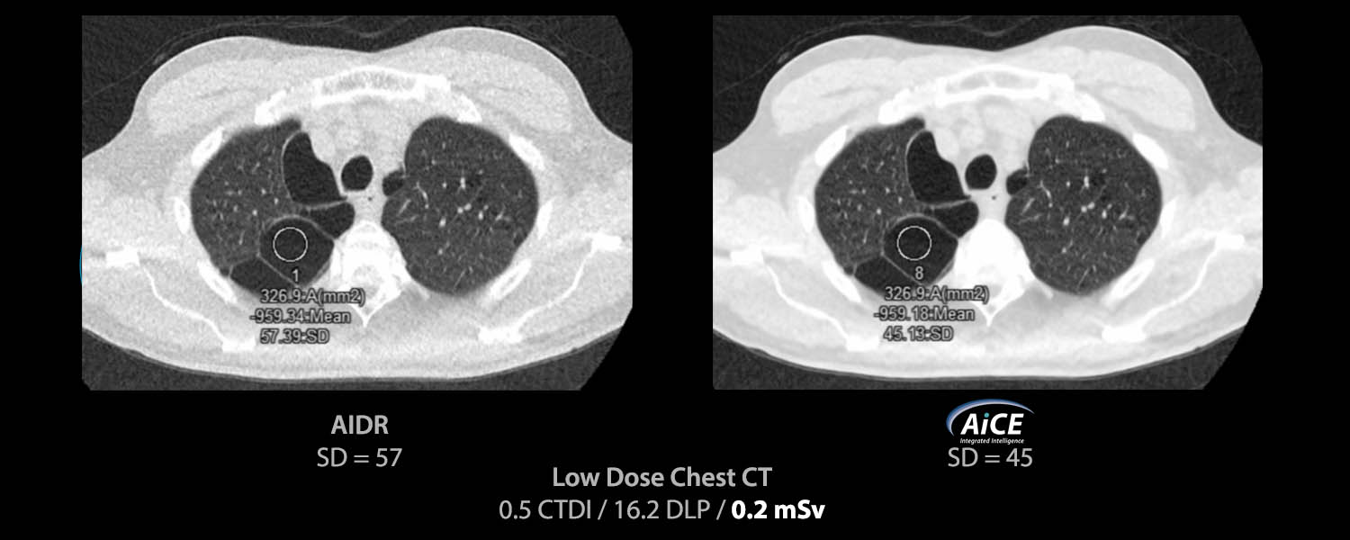 Ultra Low Dose Lung Screening