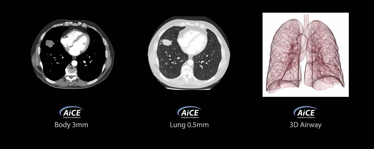 Ultra Low Dose Lung Screening
