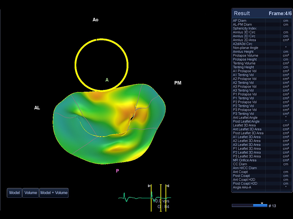 MVA (Mitral Valve Analysis) demonstrating mitral valve prolapse
