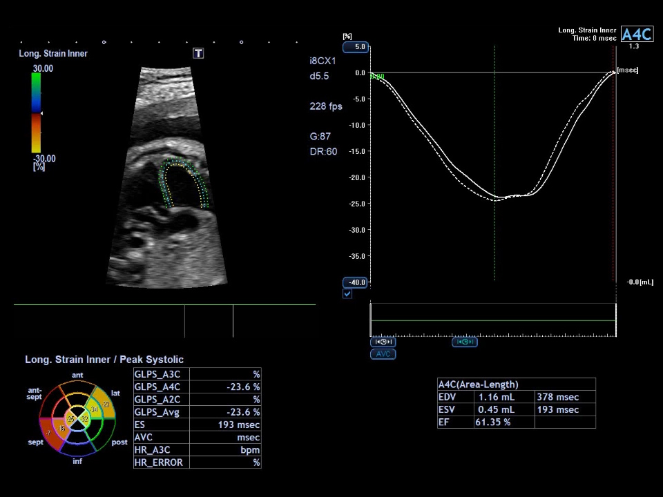 1st Trimester Abdominal Vessels ADF Pulsed Wave
