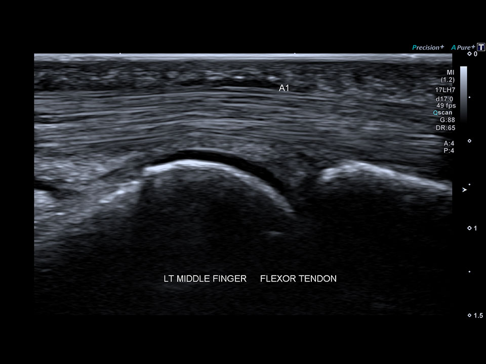 Musculoskeletal | Aplio i-series Clinical Gallery | Ultrasound | Canon ...