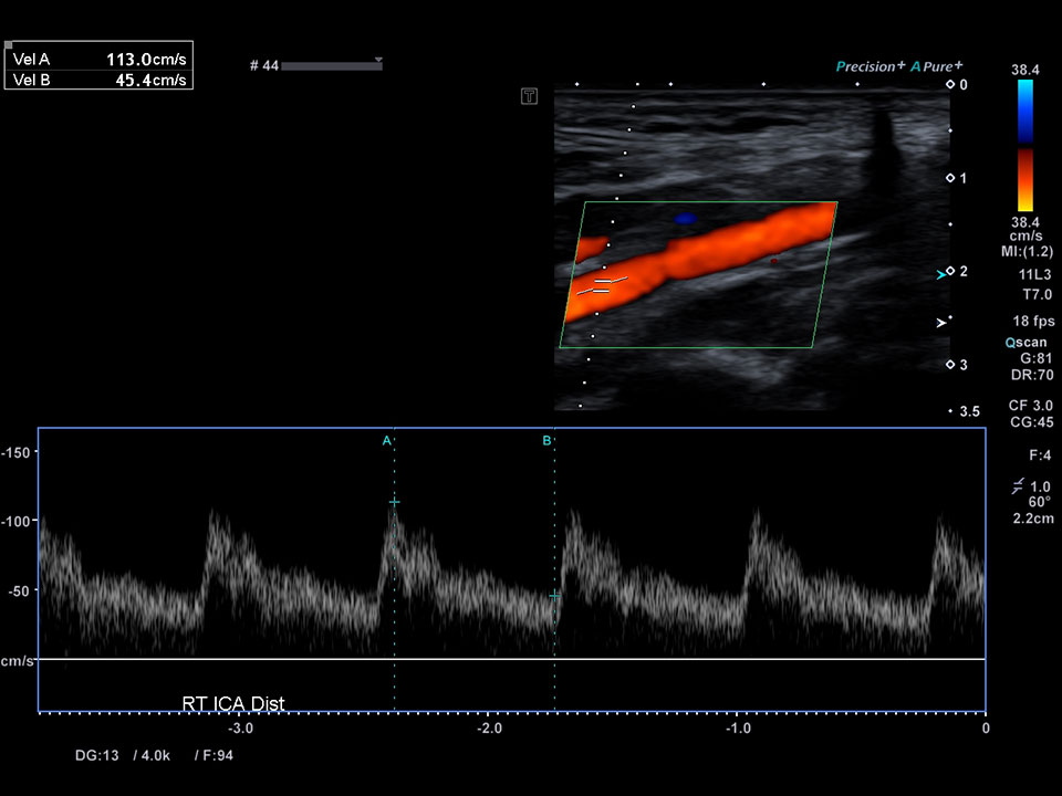 Vascular | Aplio i-series Clinical Gallery | Ultrasound | Canon Medical ...