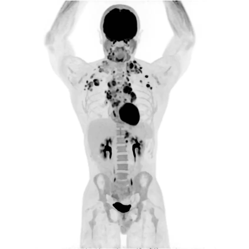Hodgkin’s Lymphoma