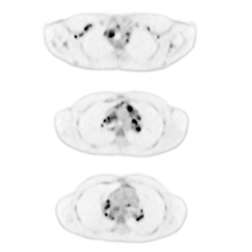 Hodgkin’s Lymphoma