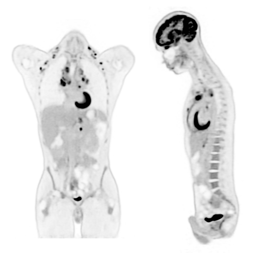 Hodgkin’s Lymphoma
