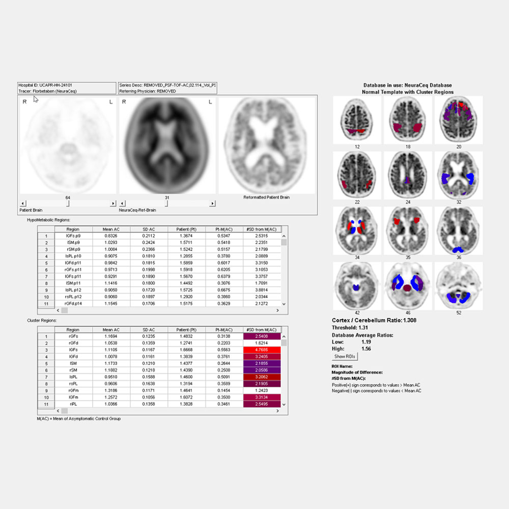 Brain, NeuraCeq (F-18 Florbetaben) Imaging