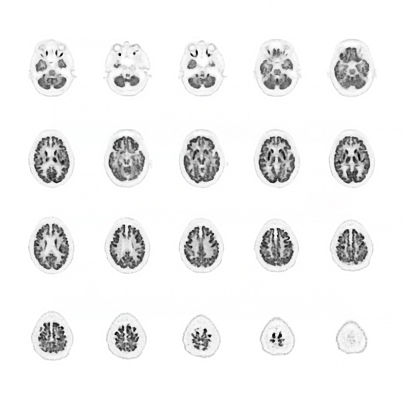 FDG Neuro PET Imaging