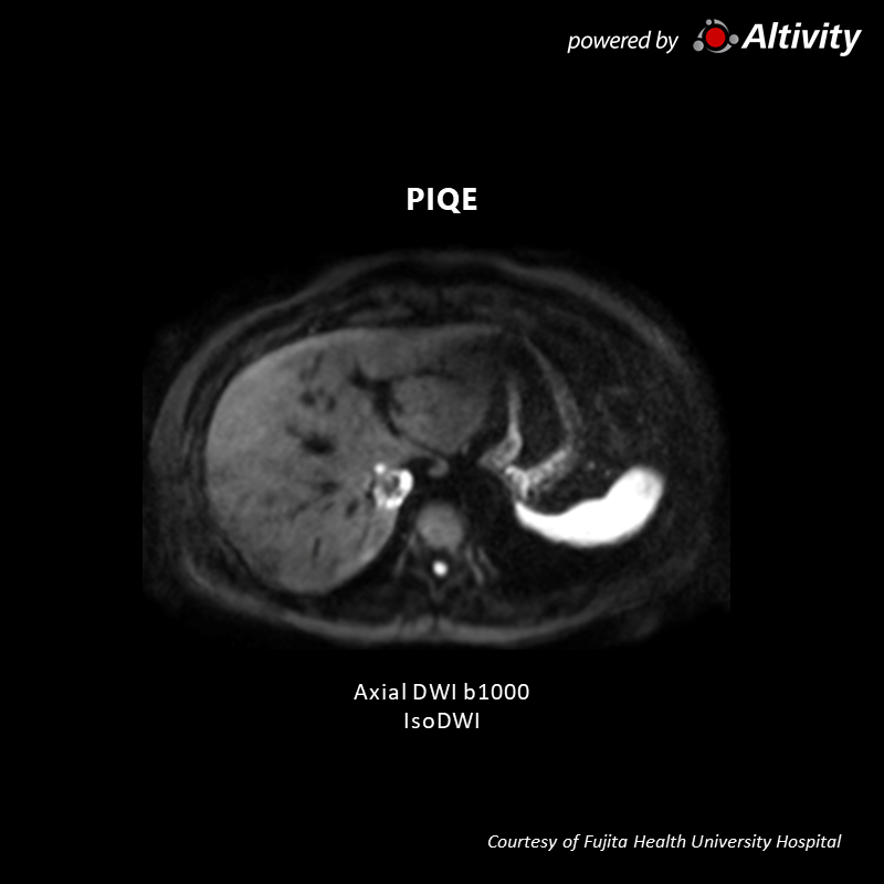 Multiple Hepatic Hyper-Vascularized Tumors