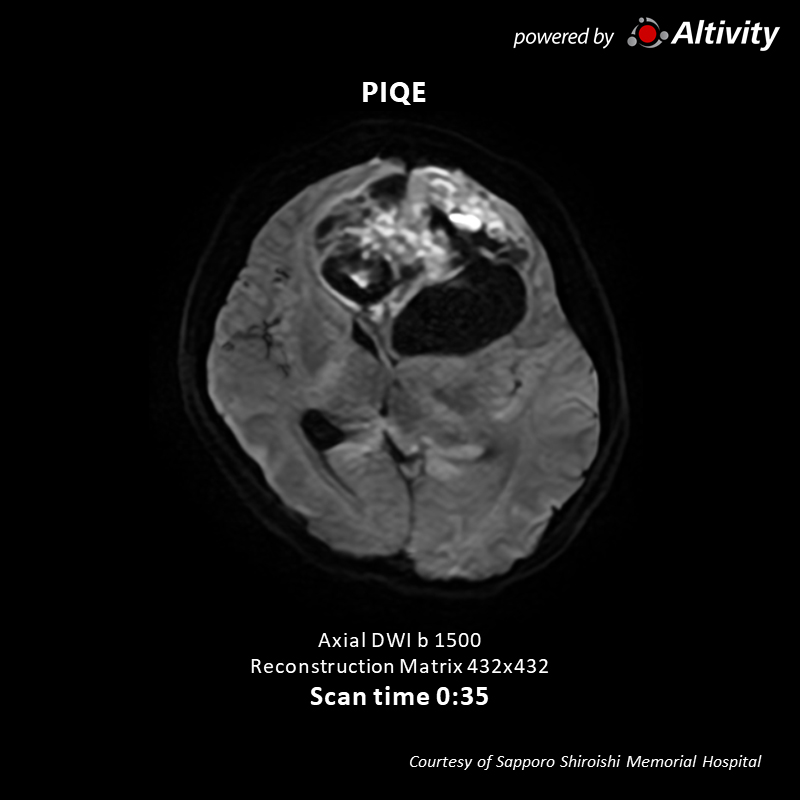 Brain tumor