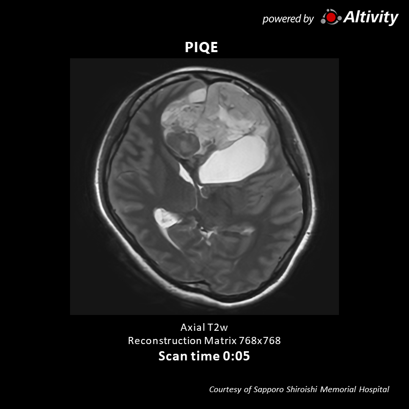 Brain tumor