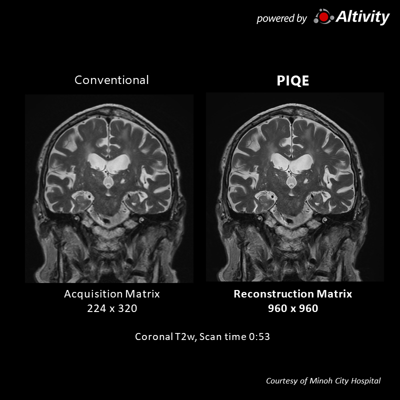 Postoperative lung cancer cranial metastasis