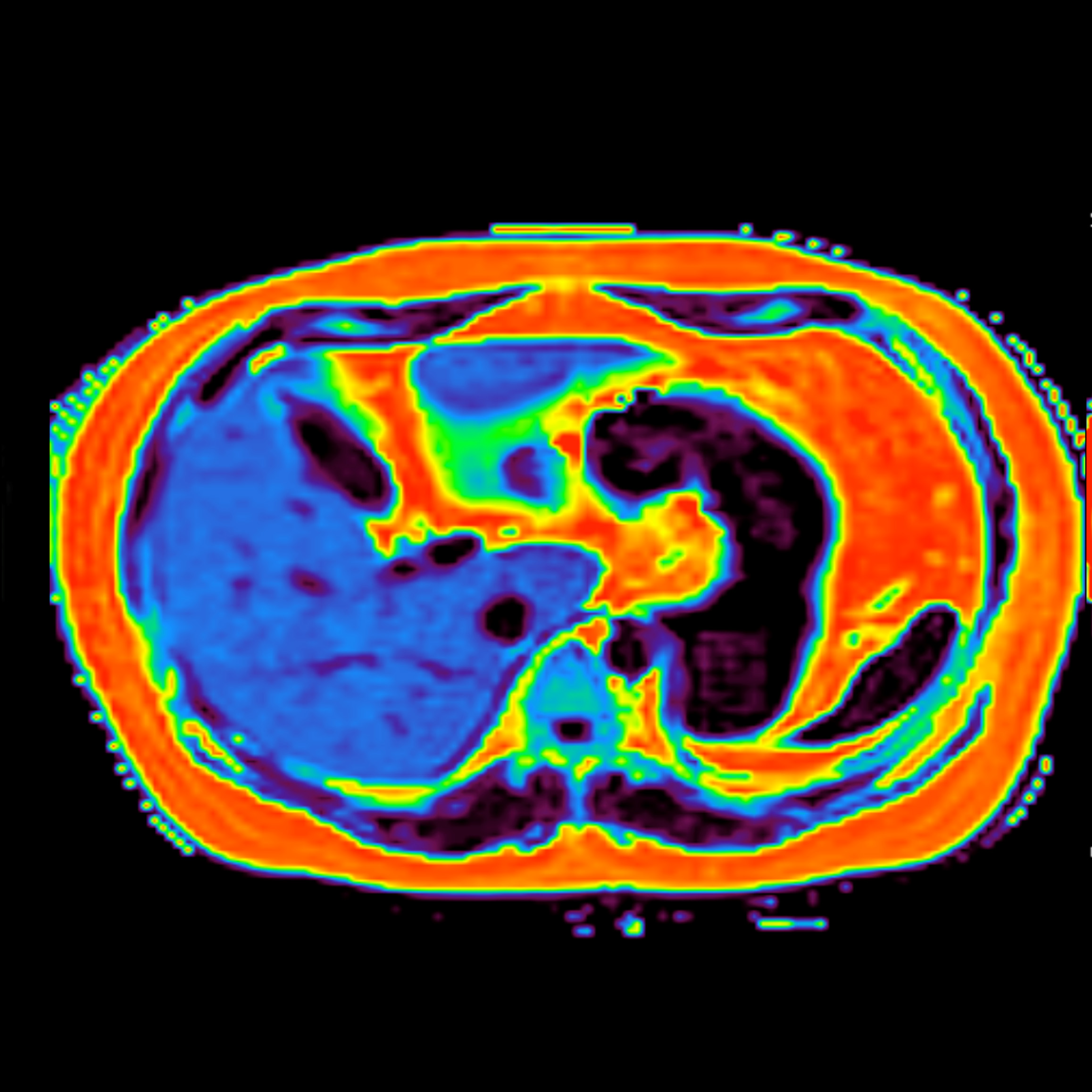 Non-Invasive Fat Imaging and Quantification