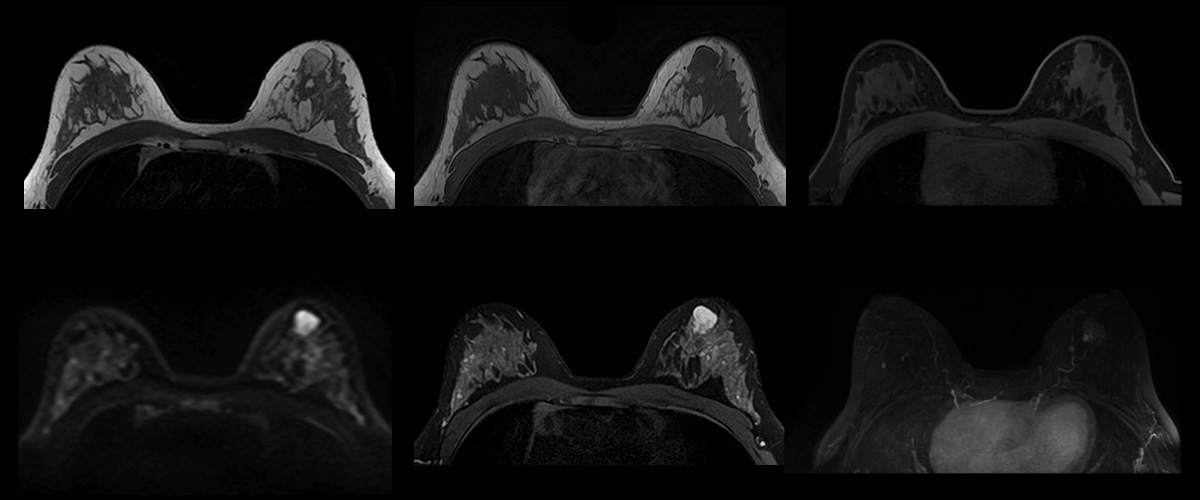 Breast | Vantage Galan 3T / Supreme Edition Clinical Gallery | MRI