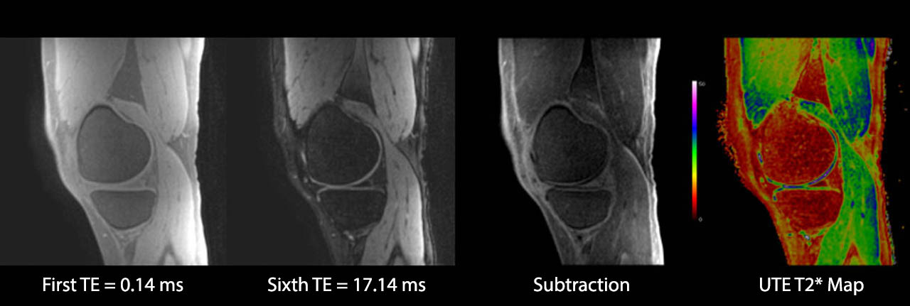 Ultra-Short TE (UTE) Imaging of the Knee