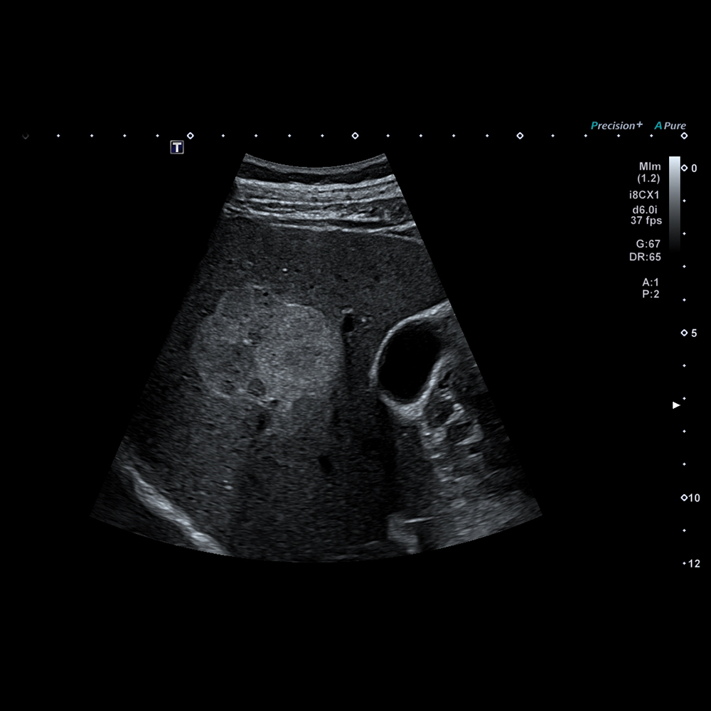 Liver Hemangioma