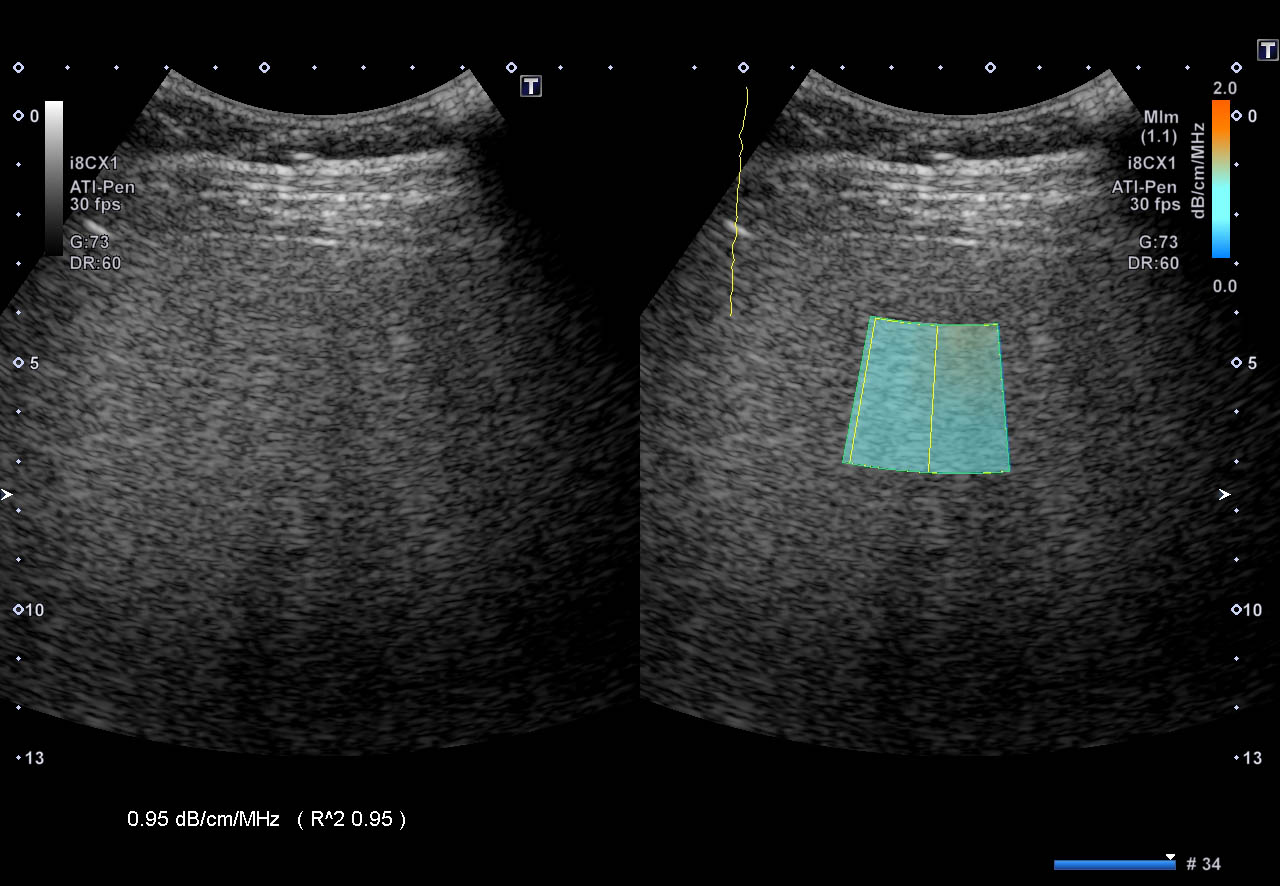 Attenuation Imaging