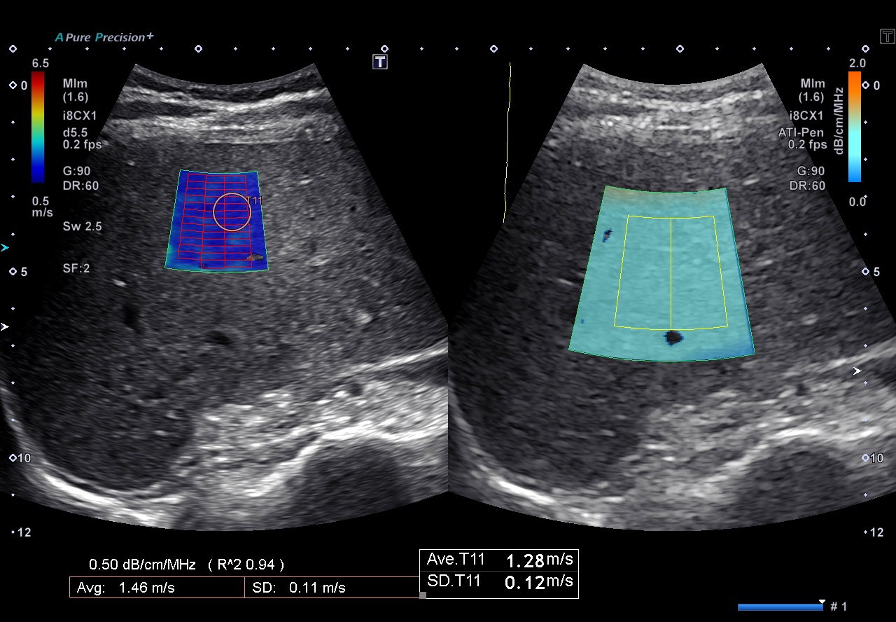 Simultaneous SWE + Attenuation Imaging