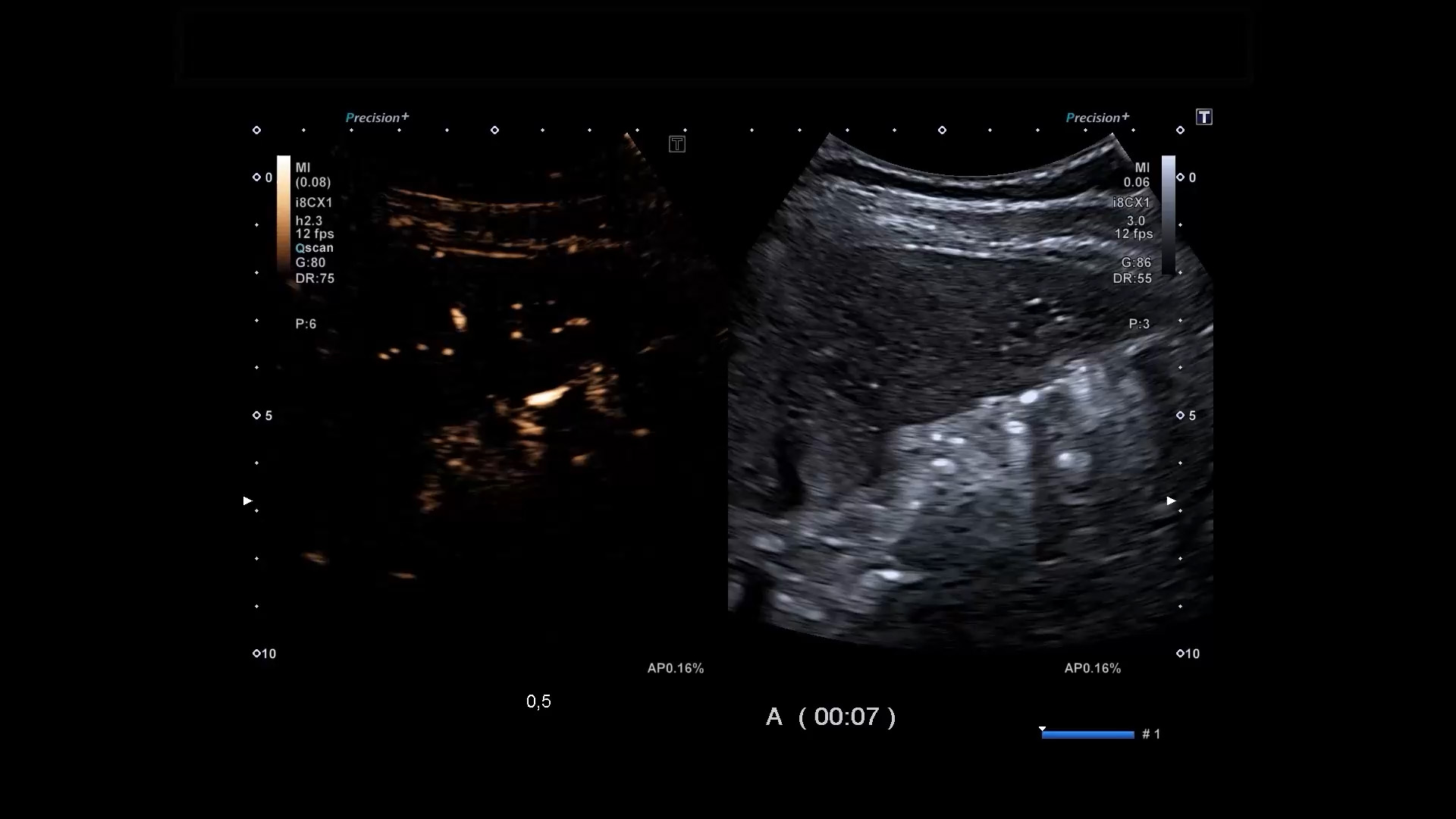 CHI (Contrast Harmonic Imaging)