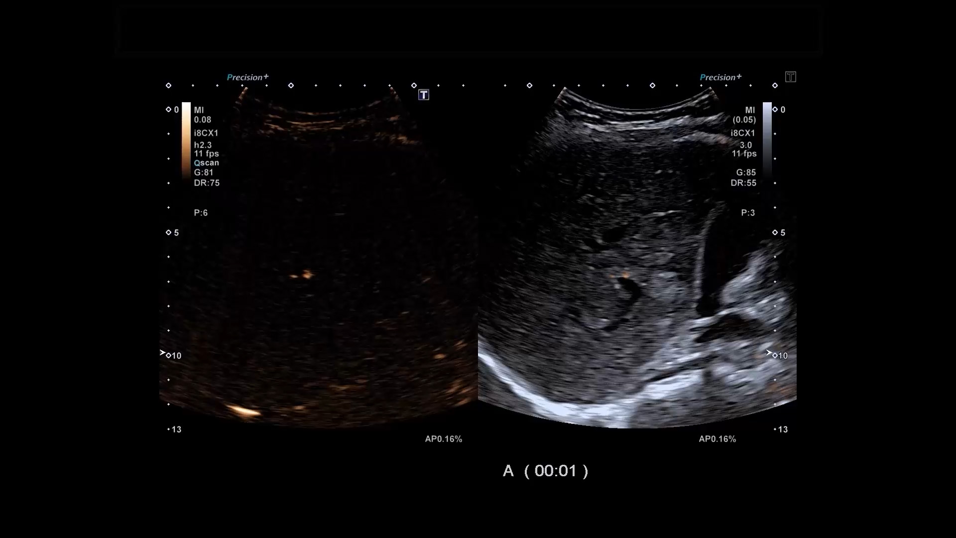 CHI (Contrast Harmonic Imaging)