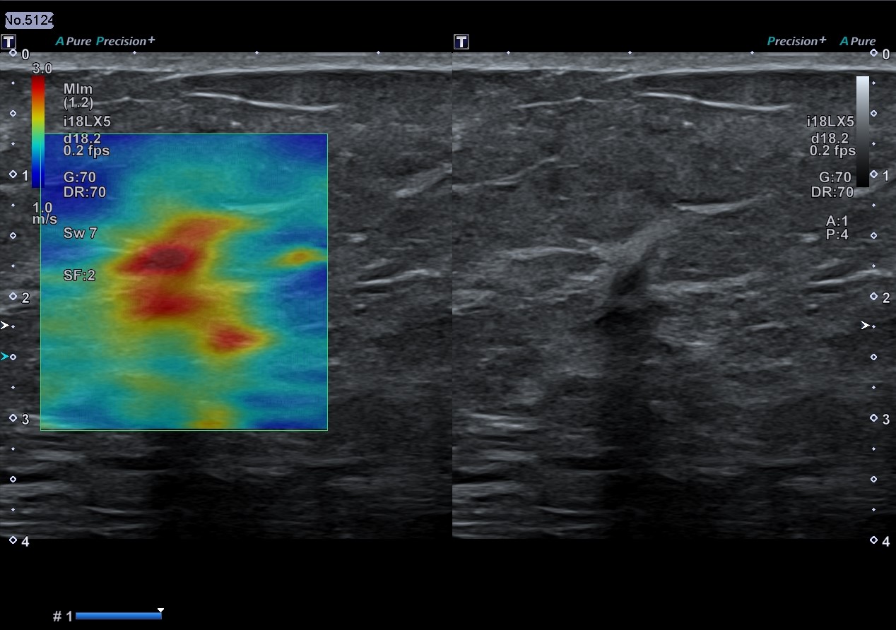 Shear Wave Elastography in a BI-RADS® 5 mass