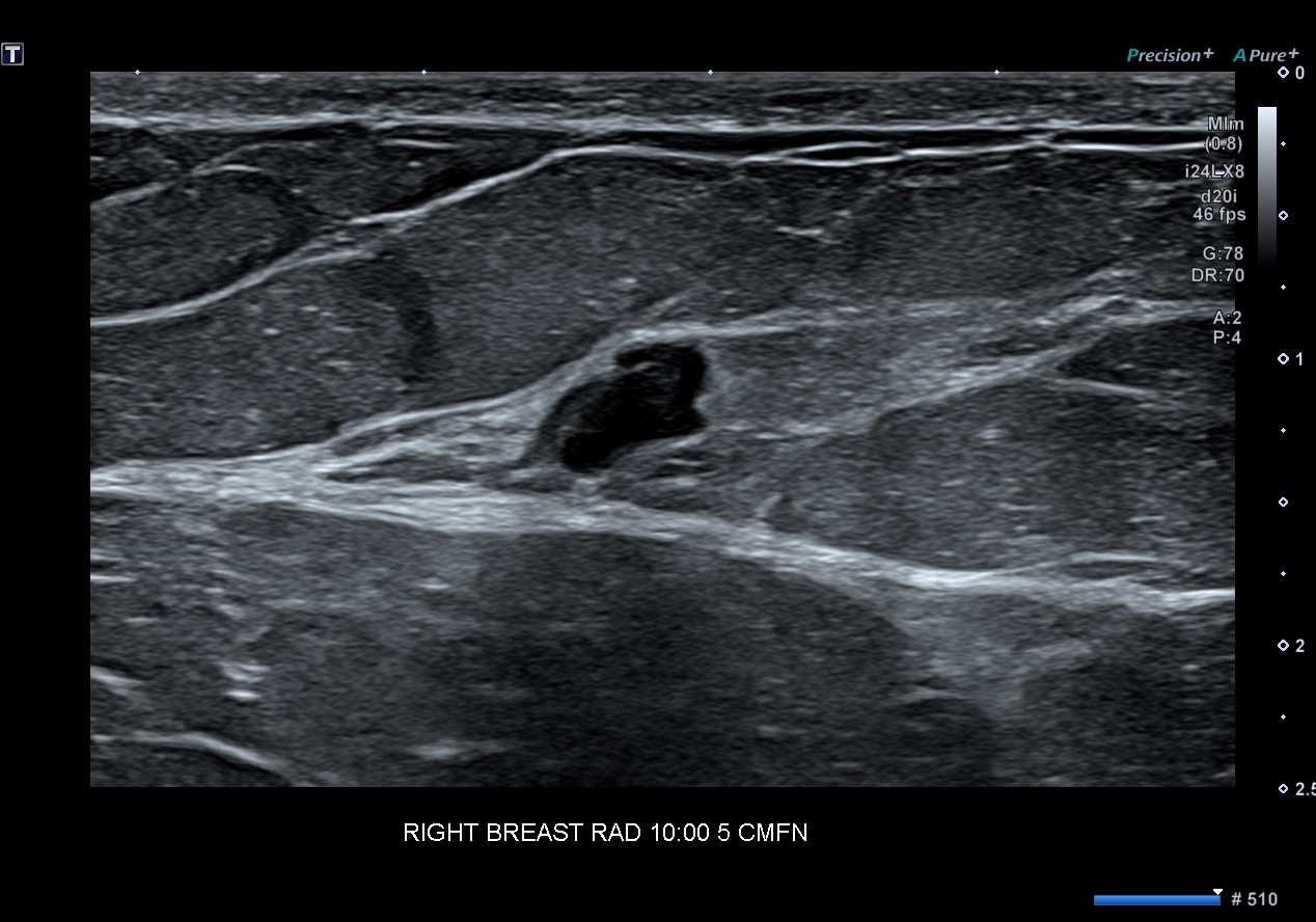 6 mm Complex Cyst with Internal Echoes