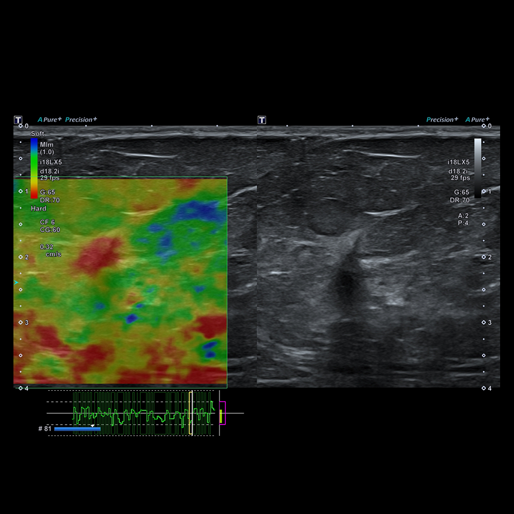 Strain Elastography Breast