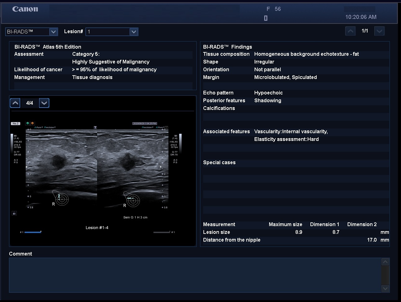 Breast Bi-Rads Report ACR 5 Lesion