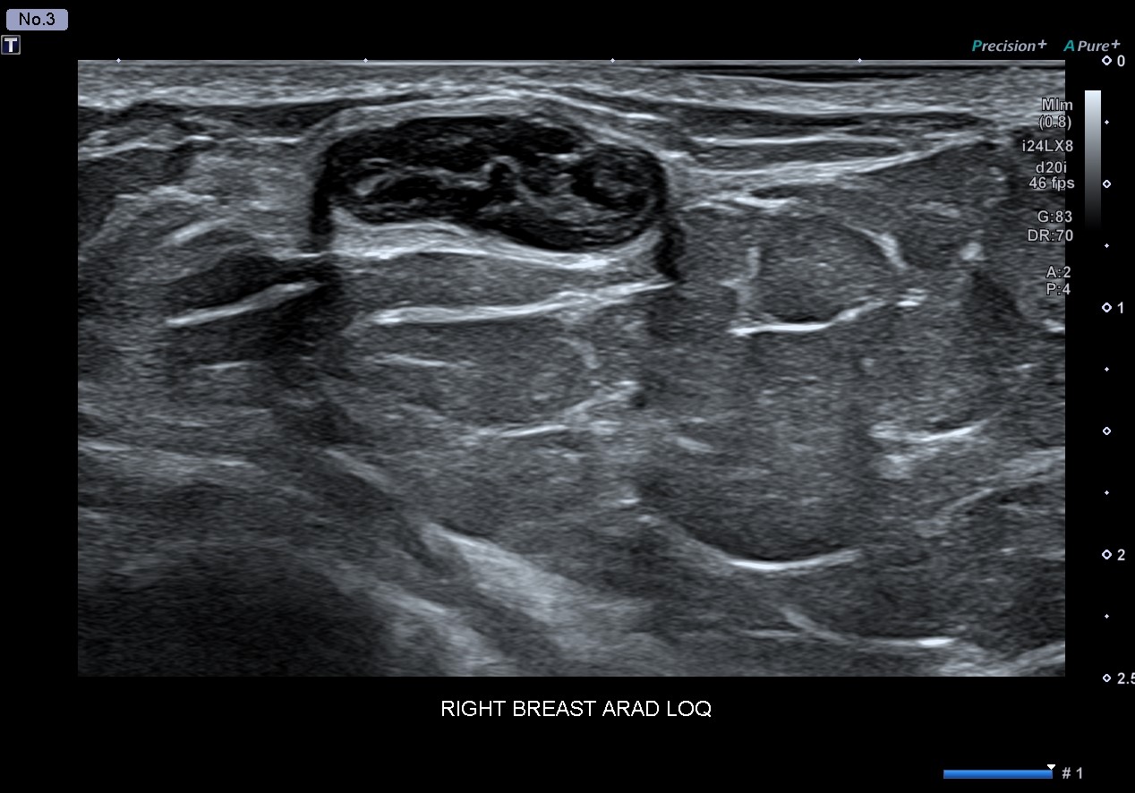 Fat Necrosis Under Skin, 24 MHz