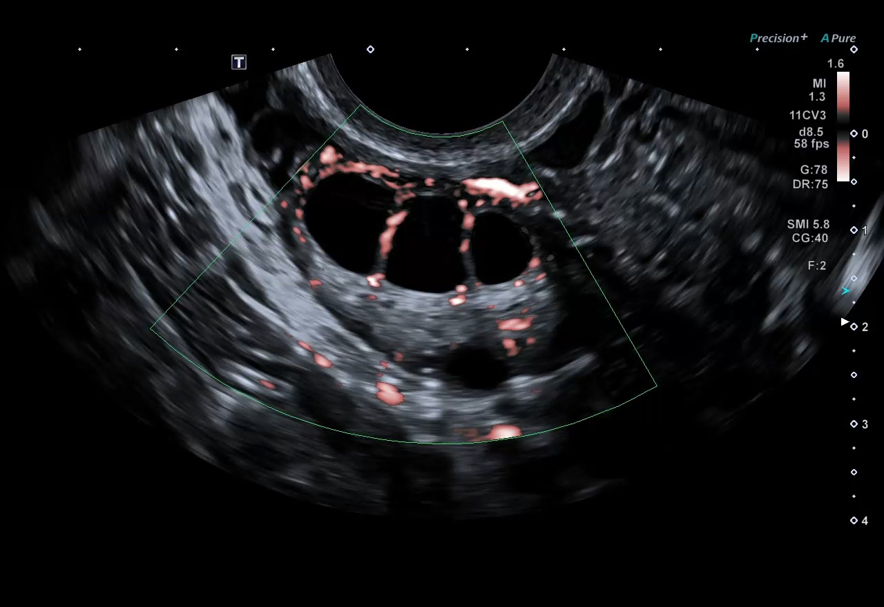 Ovary with SMI