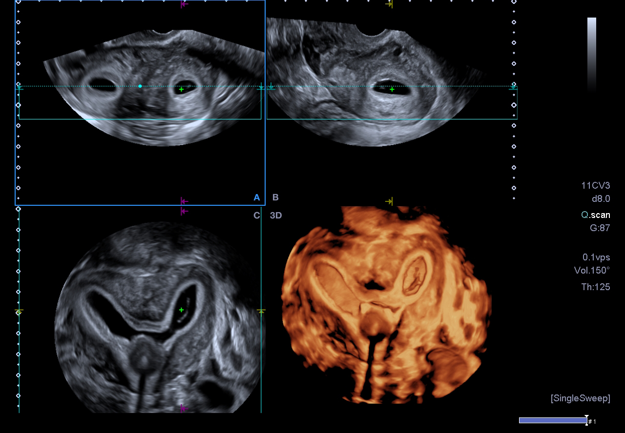 3D Uterus