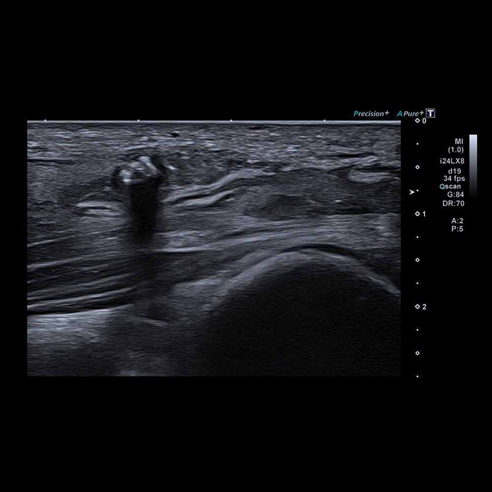 Calcification with 24 MHz