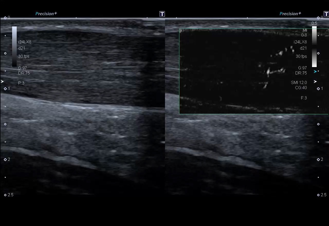 Calcaneus Tendinopathy 24 MHz mSMI