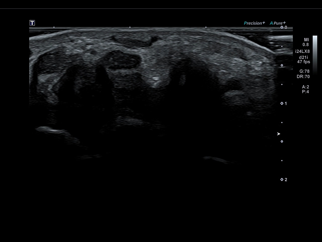 Wrist, Nerve Mass (24 MHz)