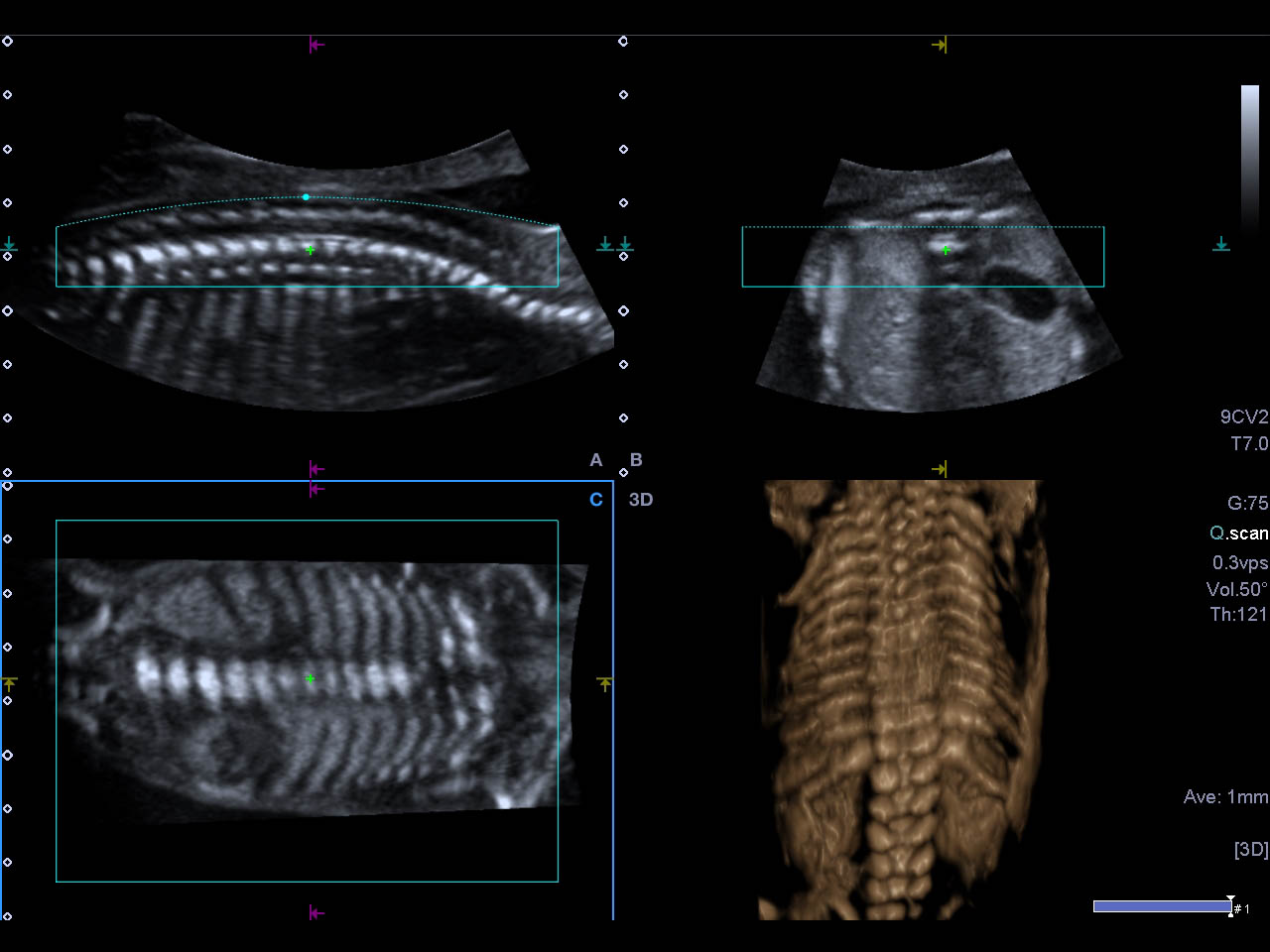 3D Fetal Spine