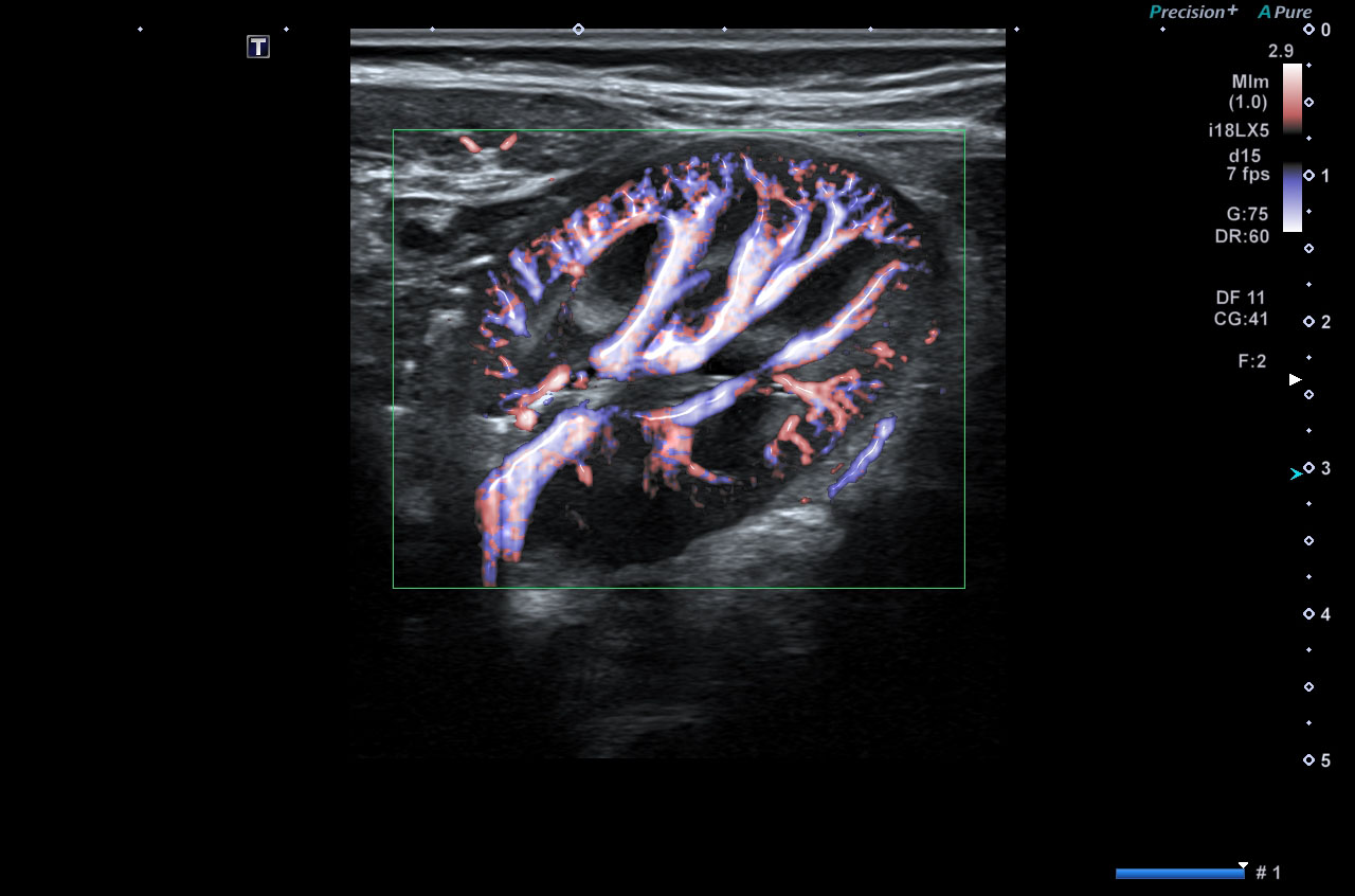 Kidney Advanced Dynamic Flow (ADF) Doppler Luminance