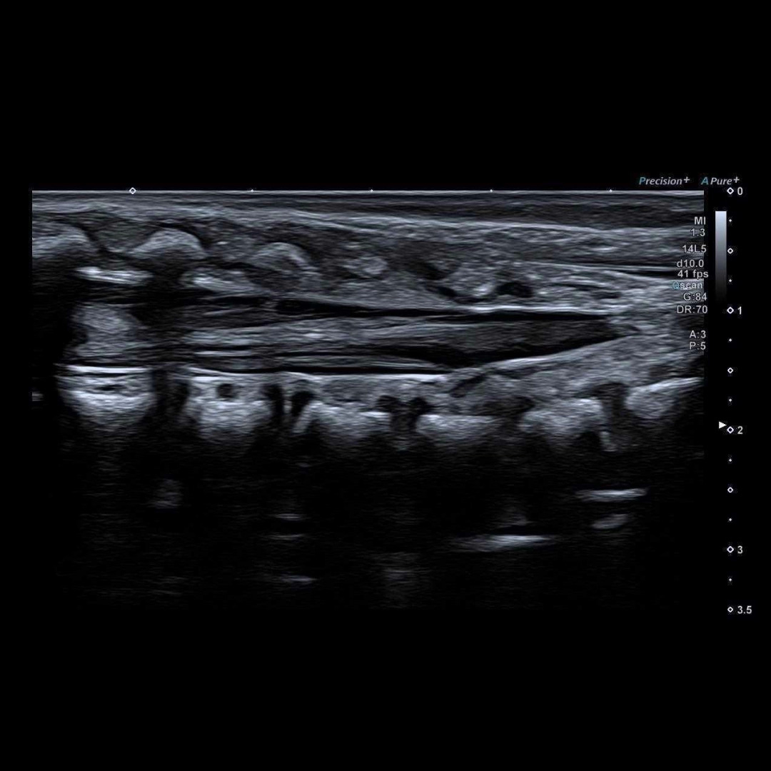 Neonatal Spine