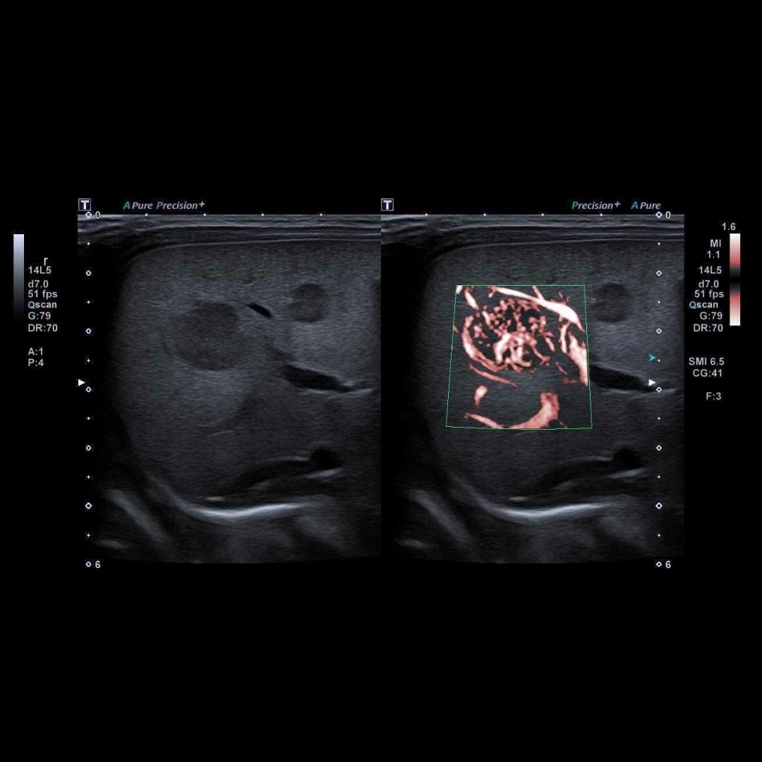 Liver Mass with cSMI